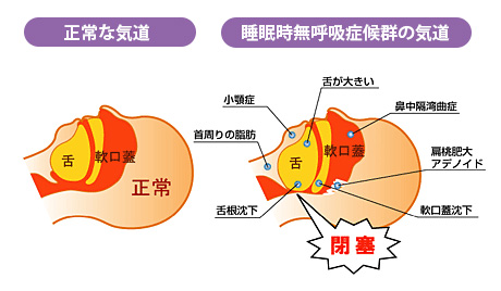 睡眠時無呼吸症候群の種類