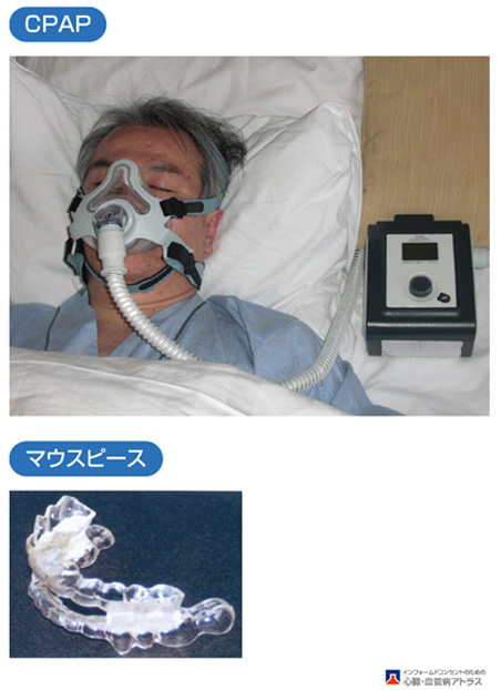 睡眠時無呼吸症候群(SAS)の治療