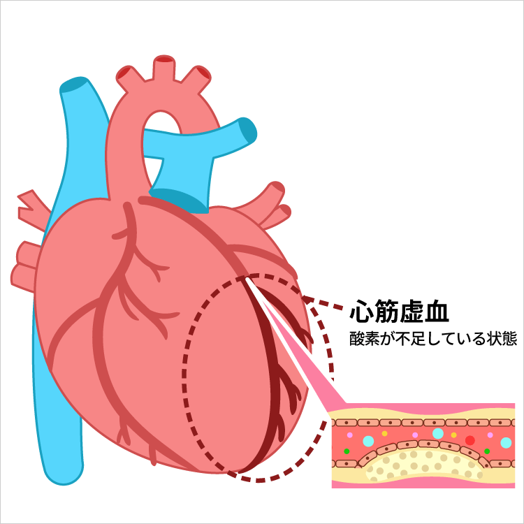 冠動脈疾患（狭心症、心筋梗塞）の原因