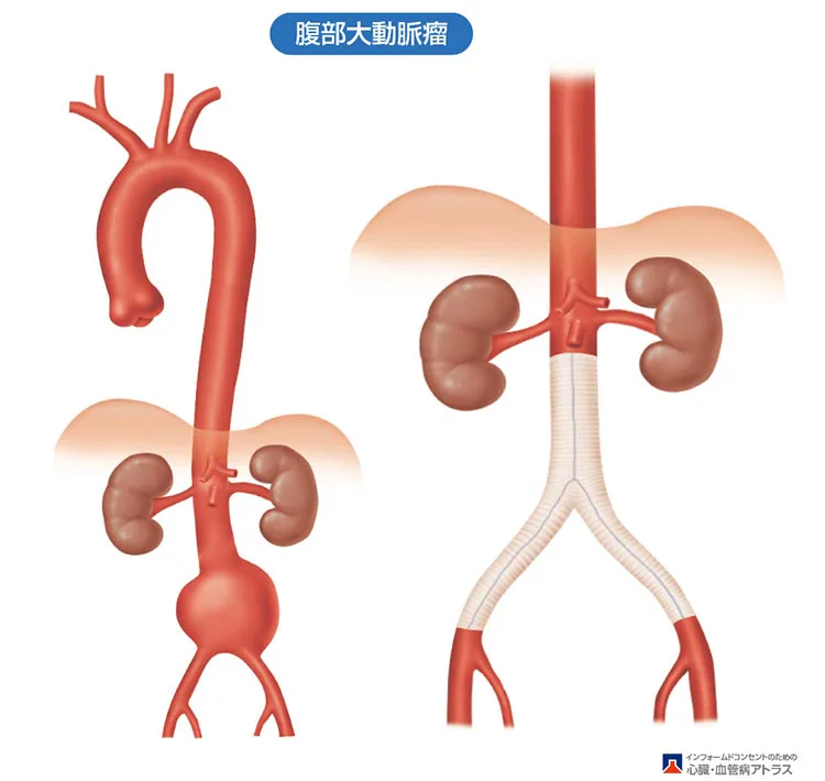 大動脈瘤の治療