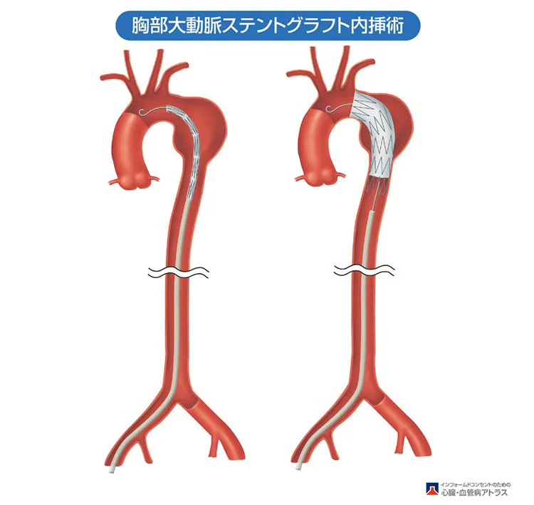 大動脈瘤の治療02