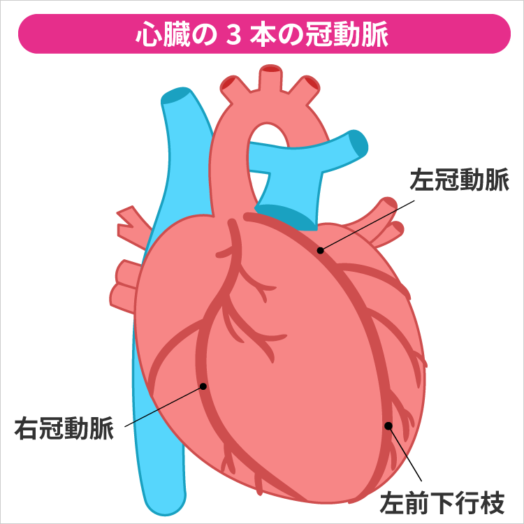 心臓病の代表は冠動脈疾患です