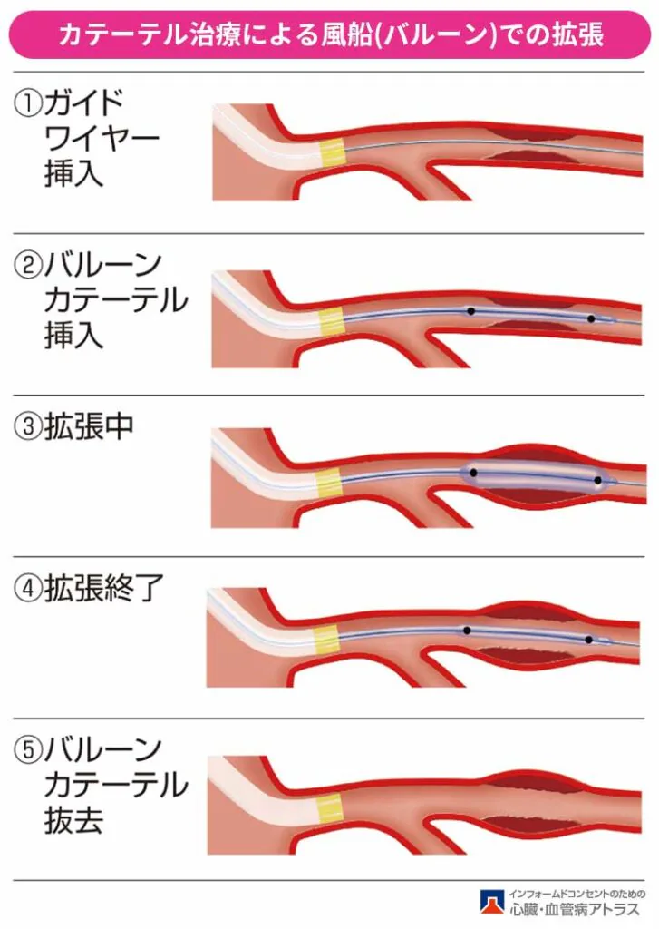 狭心症の治療