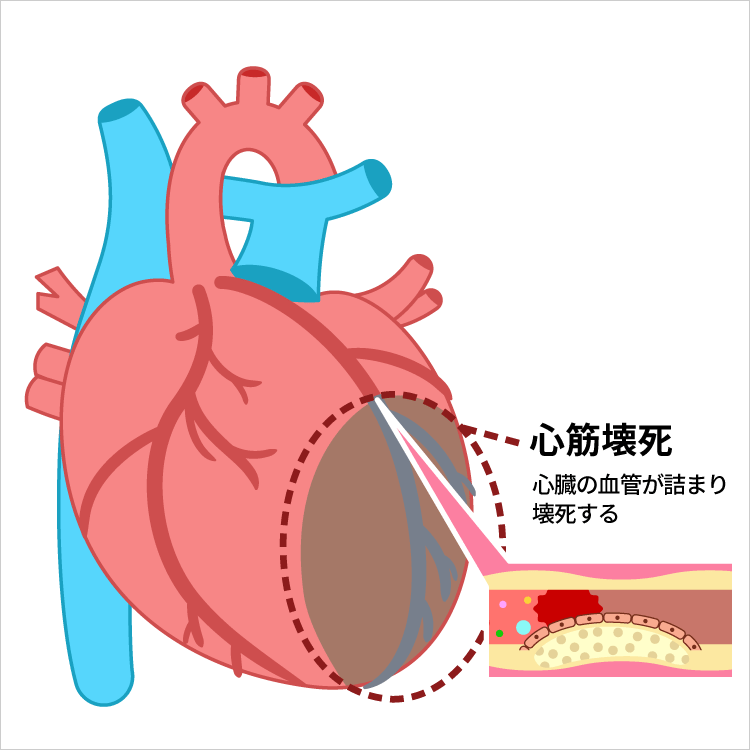 心筋梗塞とは