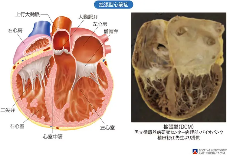 心筋症とは