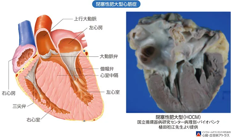 心筋症とは