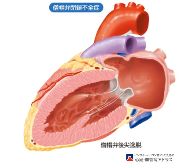 心臓弁膜症とは04