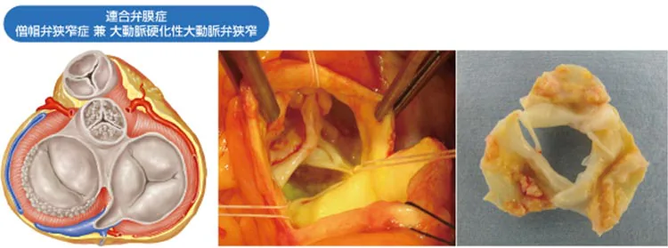 心臓弁膜症とは05