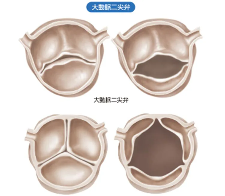心臓弁膜症とは06